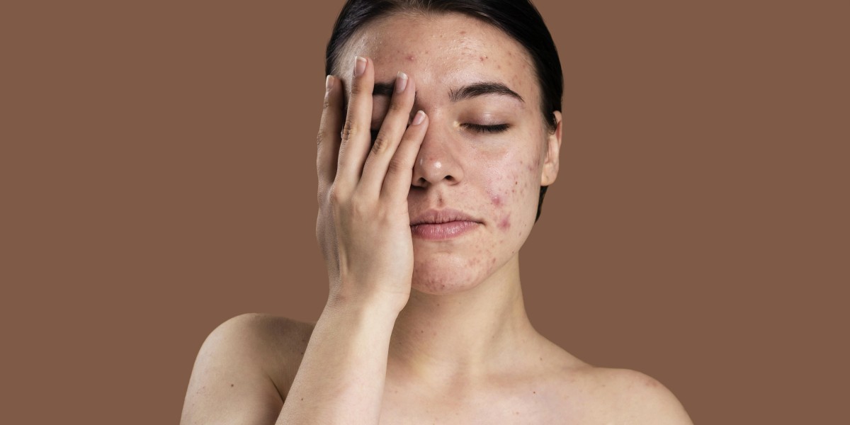 The Future of Skincare: AI Beauty Tech Solution and Acne Face Map and Solutions