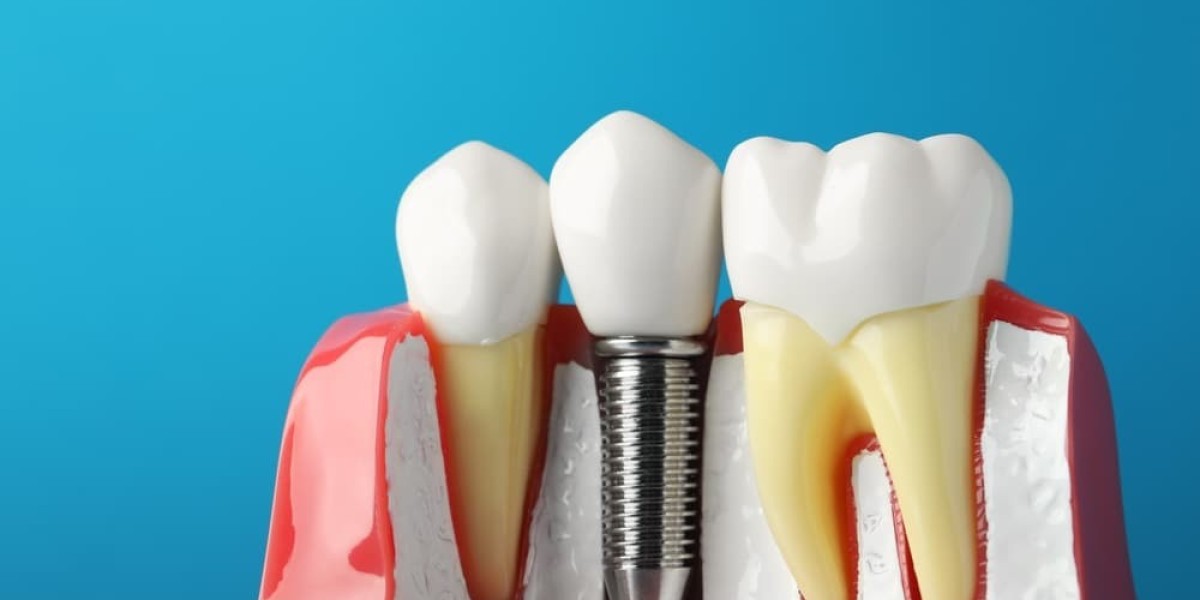 Balancing the Books on Your Smile: Understanding Dental Implant Cost in Hayward, WI