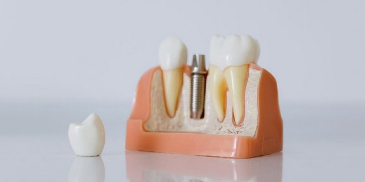 Understanding Dental Implants: A Durable Solution for Missing Teeth