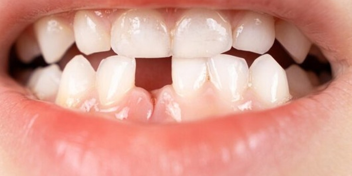 Surprising Facts about Missing Teeth You Should Know
